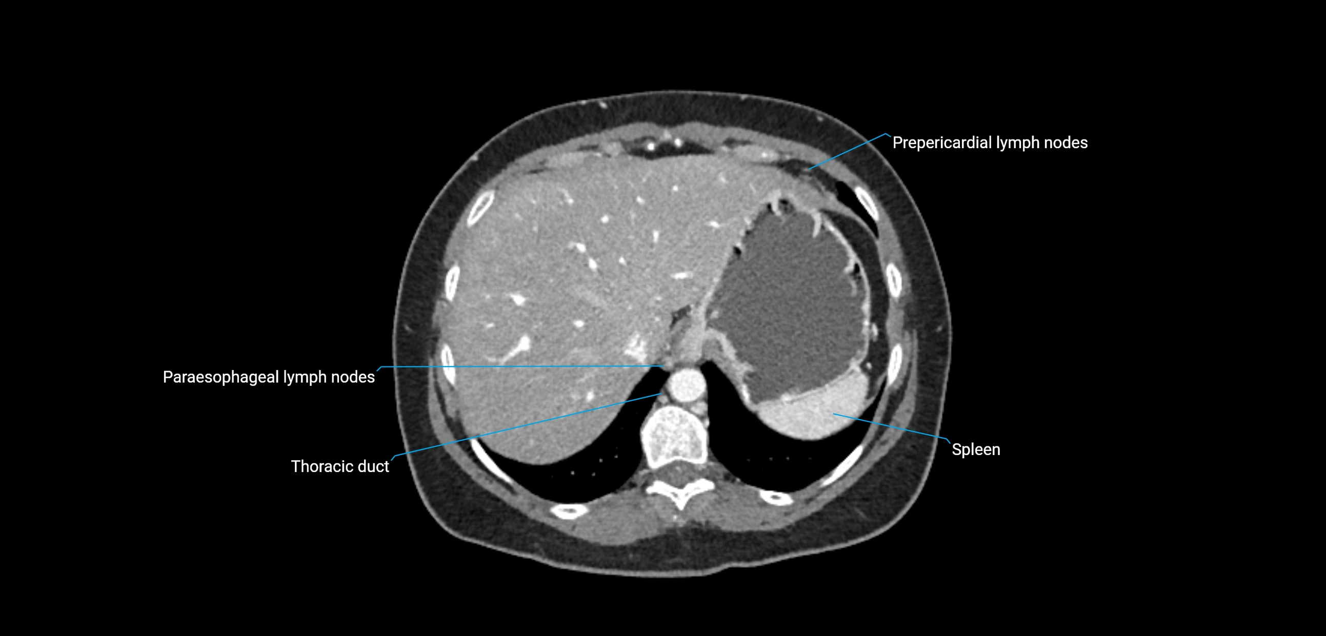 CT ct abdominal lymph nodes  axial cross sectional anatomy  enchanced radiology image -img-00002-00091.webp